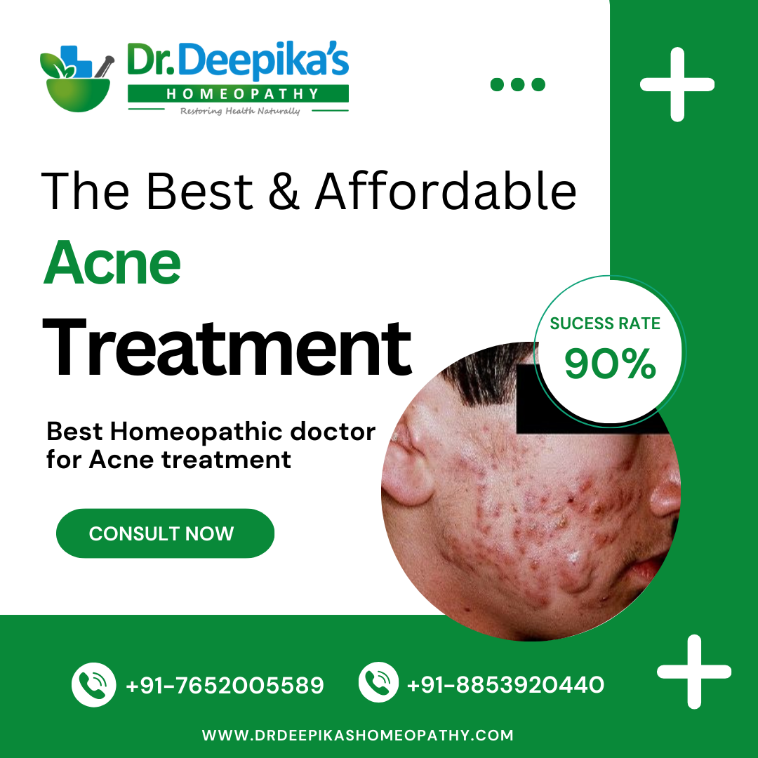 Get Affordable and Best Acne Treatment