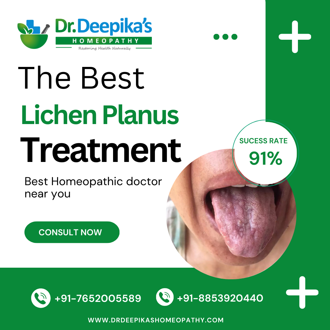 Get Affordable and Best Lichen Planus Treatment