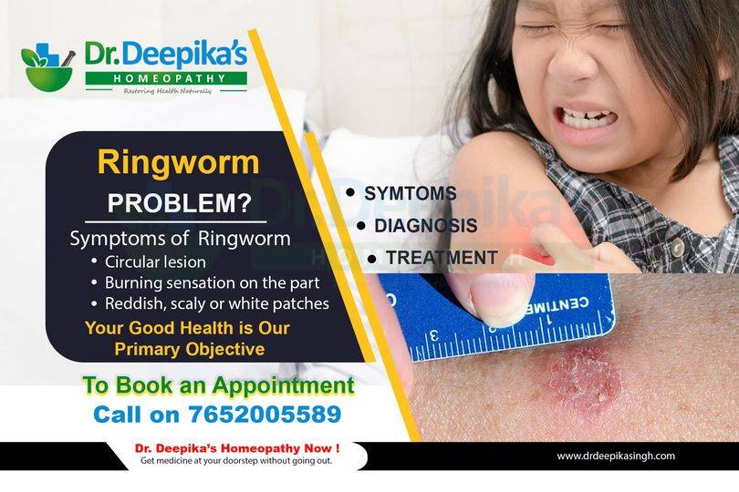 What is Ringworm & How it can be cured using homeopathy?