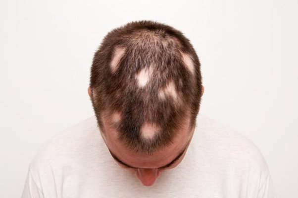 What is Alopecia areata(सिर के बालों का जगह-जगह से झड़ना।) ? How it cured permanently using homeopathic treatment.