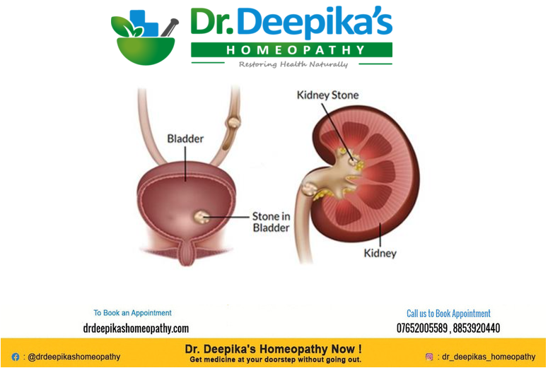 Urinary stones treatment from Dr. Deepika's Homeopathy- Best homeopathic doctor near me