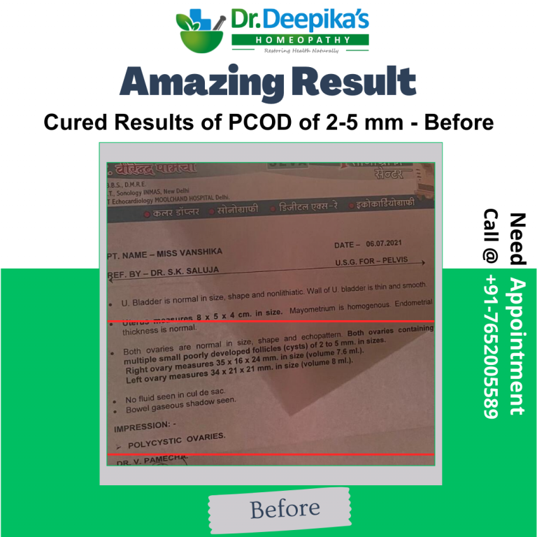 Cured Results of PCOD of 2-5 mm of Miss Vanshika at Dr. Deepika's Homeopathy Before